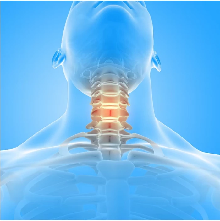 دیسک گردن چیست؛ خلاصی از دردهای ناشی از آن 8 درمان دیسک گردن