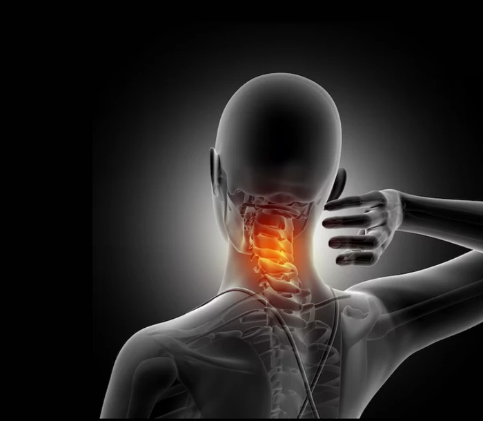 دیسک گردن چیست؛ خلاصی از دردهای ناشی از آن 3 علائم دیسک گردن