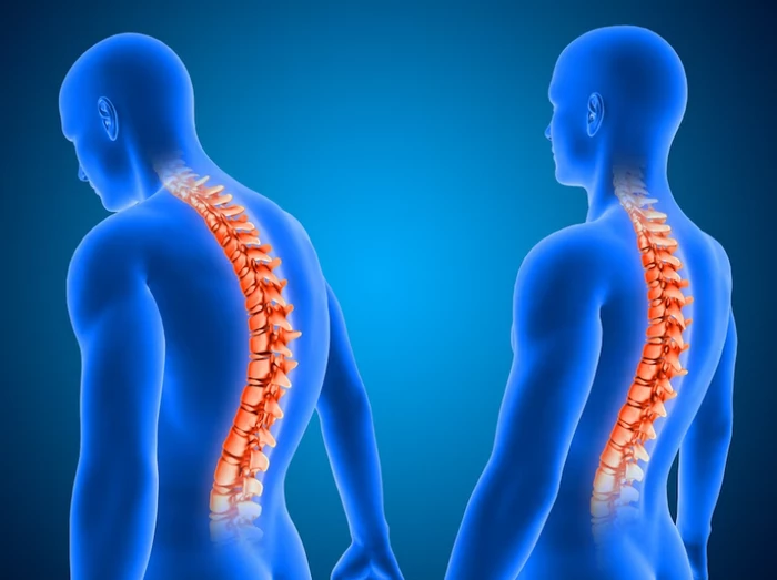 روماتیسم ستون فقرات چیست؟ 4 علائم روماتیسم ستون فقرات چیست؟