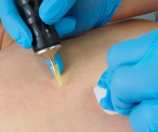 کربوکسی تراپی چیست و انجام آن چه فایدهای برای پوست دارد؟ 1 کربوکسی تراپی