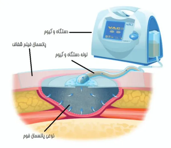 وکیوم تراپی چیست و چگونه فرد بیمار را درمان میکند؟ 8 وکیوم تراپی