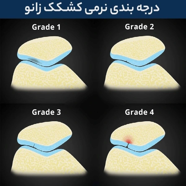 علتها ، راههای درمان و علائم نرمی کشکک زانو 8 نرمی کشکک زانو