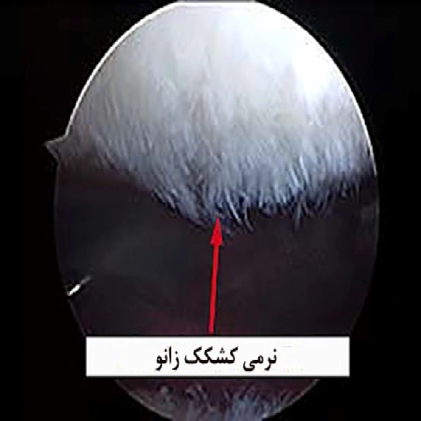 علتها ، راههای درمان و علائم نرمی کشکک زانو 10 علت نرمی کشکک زانو