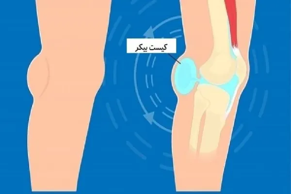 ورم پشت زانو، علت و راههای درمان آن 6 روش های درمان ورم پشت زانو