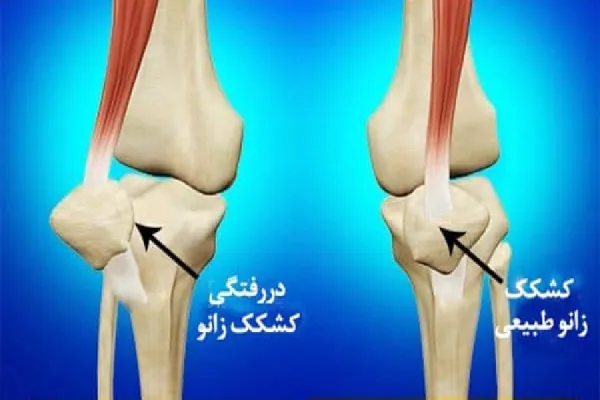 آشنایی با روشهای درمان در رفتگی زانو و علائم آن 3 در رفتگی کشکک زانو