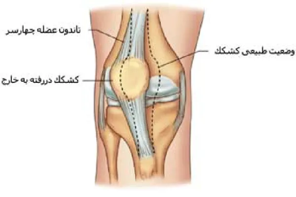 آشنایی با روشهای درمان در رفتگی زانو و علائم آن 5 علائم در رفتگی کشکک زانو