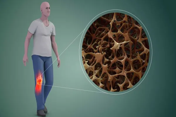علتها، علائم، روشهای تشخیصی و درمانی پوکی استخوان 7 پوکی استخوان