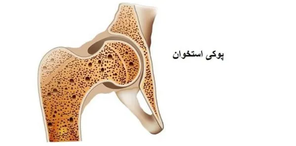 علتها، علائم، روشهای تشخیصی و درمانی پوکی استخوان 8 پوکی استخوان چیست