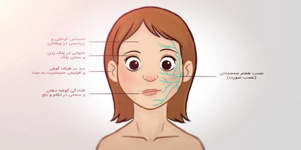 علتها، علائم، روشهای درمانی و تشخیصی فلج بلز یا فلج صورت 9 فلج صورت