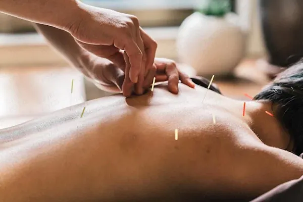 طب سوزنی 2 مزایای طب سوزنی