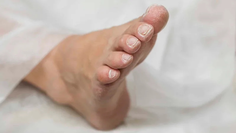 علائم پای دیابتی