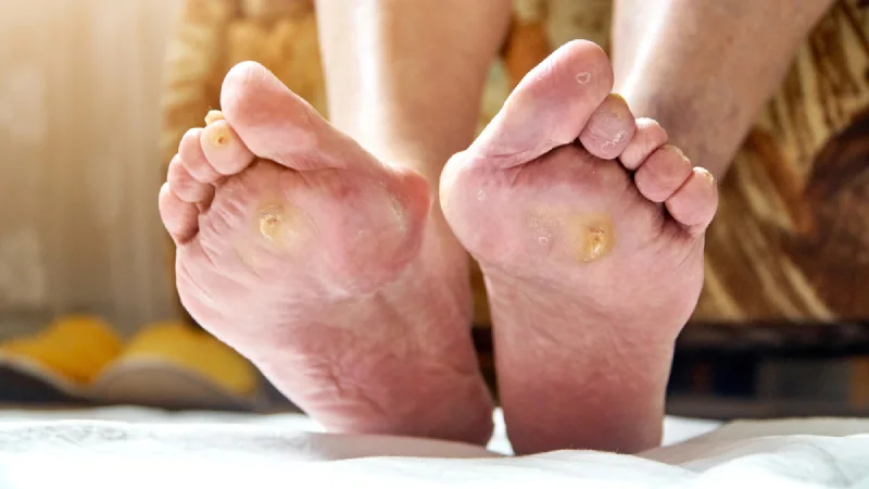 پای دیابتی