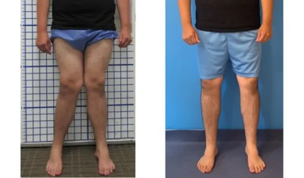 با حرکات اصلاحی زانوی ضربدری از درد رها شوید! 5 حرکات اصلاحی زانوی ضربدری