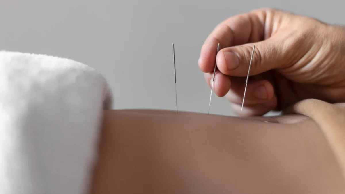 طب سوزنی برای تنبلی تخمدان