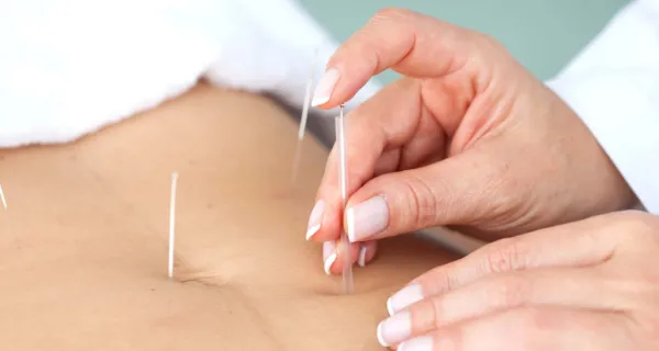 طب سوزنی برای تنبلی تخمدان؛ آیا واقعا موثر است؟ 4 طب سوزنی برای تنبلی تخمدان