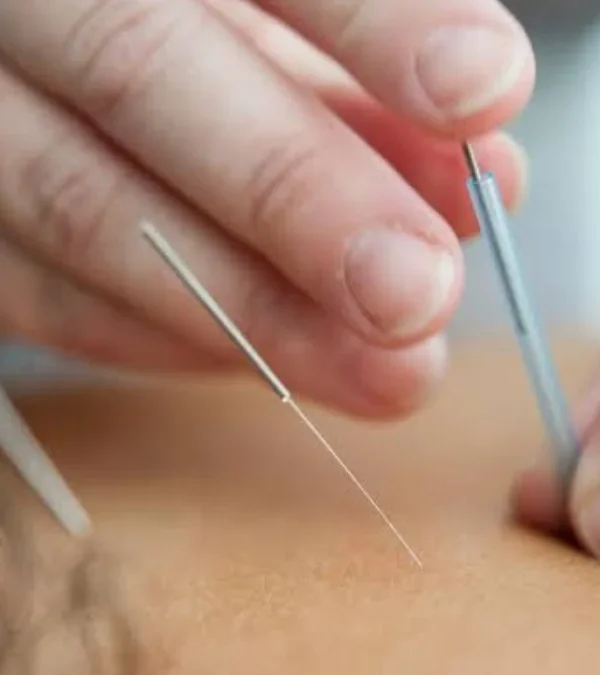 طب سوزنی یا امبدینگ