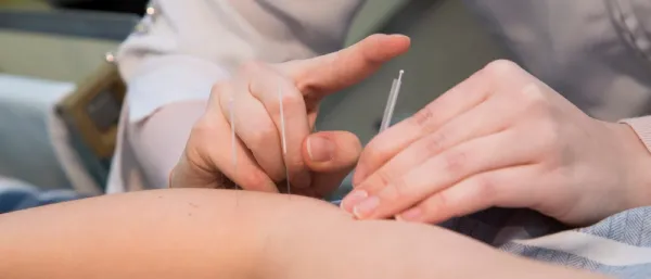 طب سوزنی یا امبدینگ