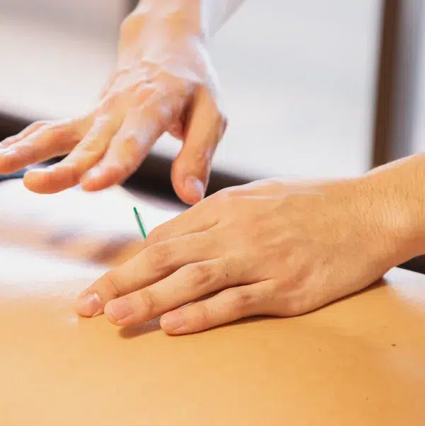 طب سوزنی یا امبدینگ؛ انتخابی مؤثر برای درمان و بهبود کیفیت زندگی 5 طب سوزنی یا امبدینگ