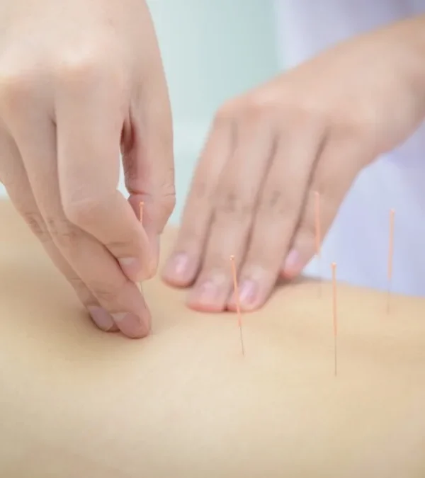 طب سوزنی برای سیاتیک
