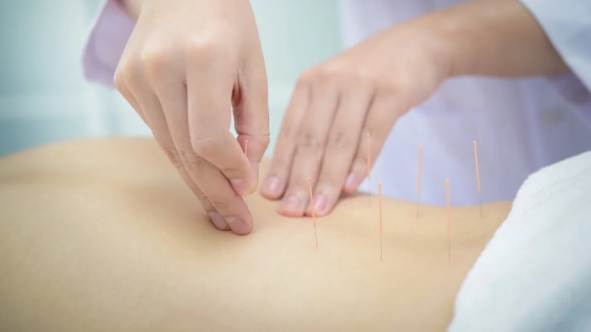 طب سوزنی برای سیاتیک
