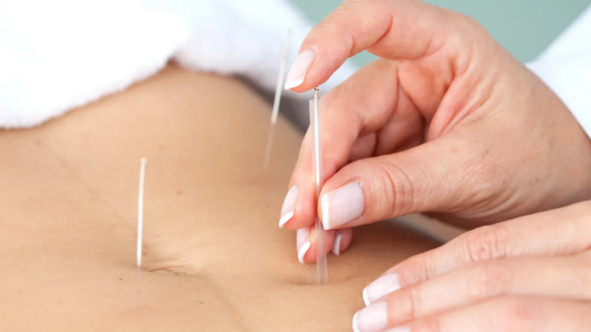 طب سوزنی برای لاغری