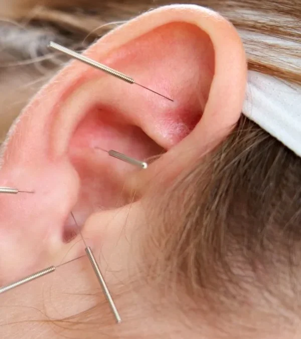طب سوزنی گوش