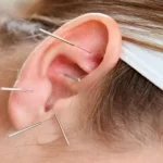 طب سوزنی گوش