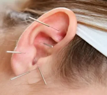 طب سوزنی گوش