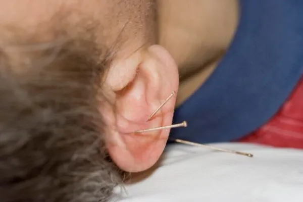 طب سوزنی گوش؛ راهنمای کامل فواید، روش درمان و عوارض 2 طب سوزنی برای گوش