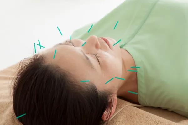 راز پوست بدون چینوچروک با طب سوزنی صورت 2 جوانسازی صورت با طب سوزنی