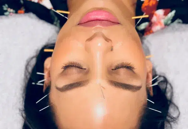 راز پوست بدون چینوچروک با طب سوزنی صورت 4 تاثیر طب سوزنی بر پوست صورت