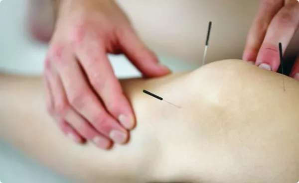 بررسی درمان طب سوزنی و گرفتگی عضلات؛ تجربهای واقعی از آرامش دوباره 6 طب سوزنی و گرفتگی عضلات