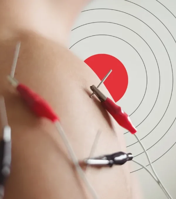 طب سوزنی الکتریکی
