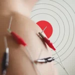 طب سوزنی الکتریکی